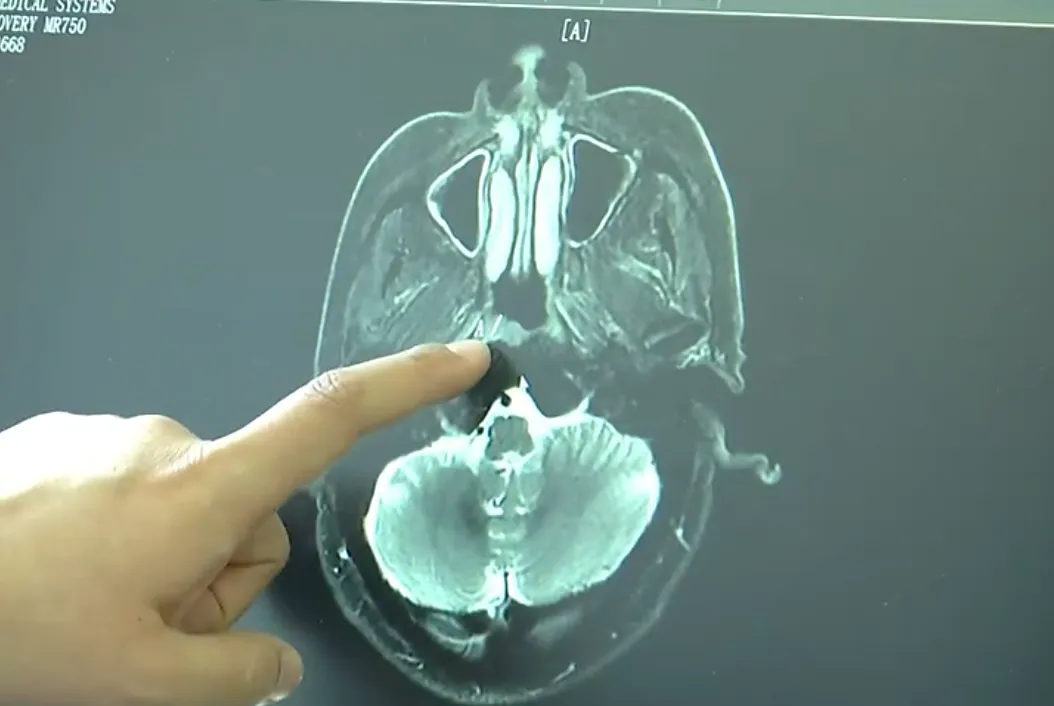 五省高发!15岁男孩患癌,只因忽视这一“小毛病”……