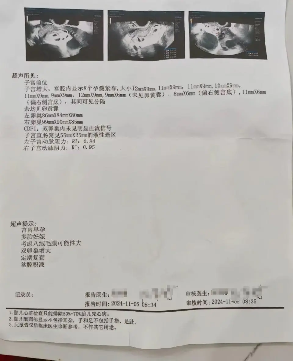 怀上9胞胎女子进行减胎手术：第一次减4个胚胎，第二次减3个胚胎