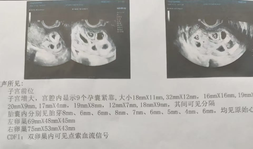 怀九胞胎女子已进行第二次减胎手术，最终留下两胎