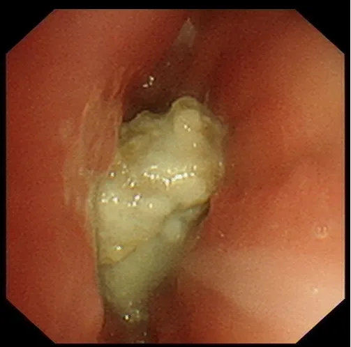 八旬老人“物”入“气”途 重医附属璧山医院呼吸科成功为其巧取异物