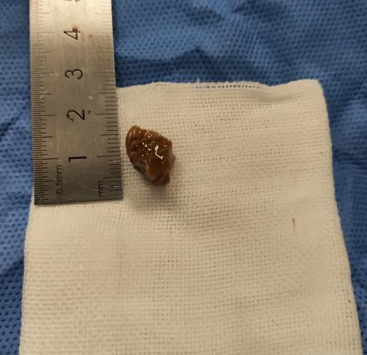 八旬老人“物”入“气”途 重医附属璧山医院呼吸科成功为其巧取异物