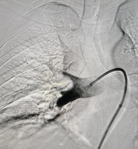 术中造影见右肺动脉内大量血栓