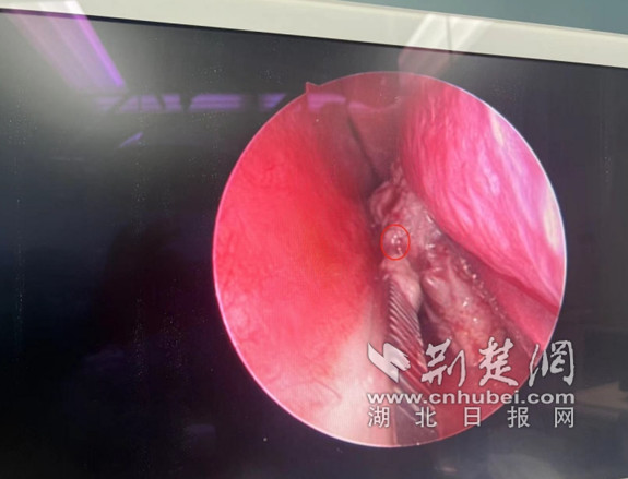 女子鼻塞鼻臭大半年 原因竟是鼻子里长了结石