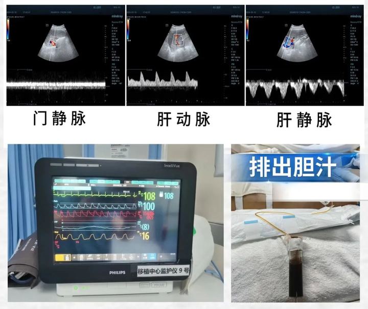 世界首例基因编辑猪肝脏移入人体，异种移植的路还有多远？