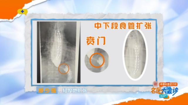 男子暴瘦求医，每次只能咽下一粒米，医生：这种病很痛苦