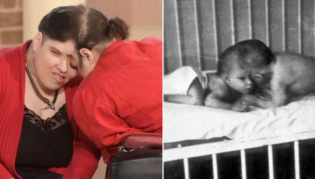 “世上最年长连体双胞胎”去世，终年62岁，死因未公开