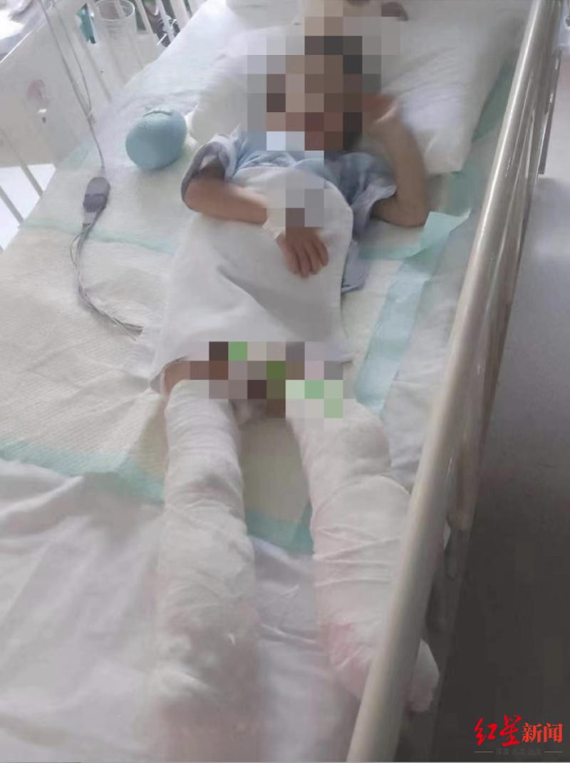 5岁男童被生母虐致双腿截肢案将再开庭 父亲：孩子仍在住院，自己现在有点矛盾了
