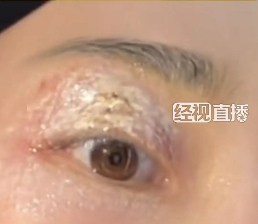 “会飞的硫酸”将进入活跃期,有人中招脖子烂了一圈