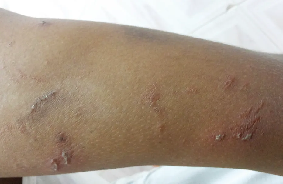 “会飞的硫酸”将进入活跃期,有人中招脖子烂了一圈