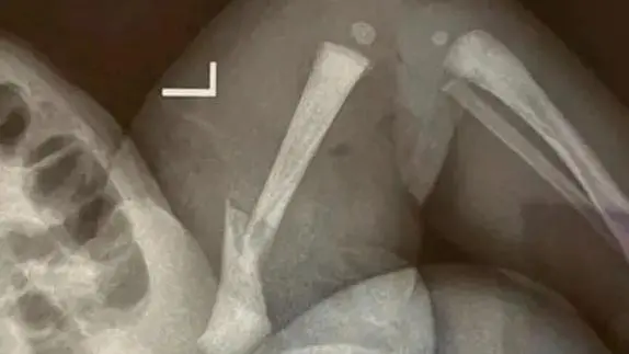 江苏靖江一新生儿骨折16小时后腿部溃烂,家长质疑系医疗事故,院方:手法不熟导致