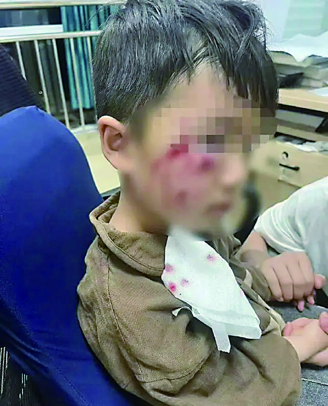 "3岁男童被狗咬伤后不幸离世"调查结果:疫苗无法确保百分之百不感染