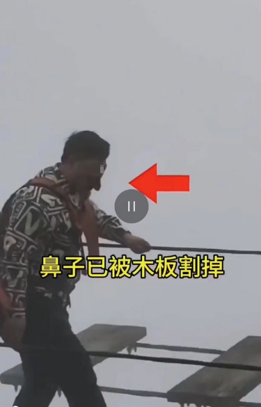 游客贵州铜仁玩“步步惊心”桥被割鼻子？当地文旅局：未割掉，是磕破了，已送医