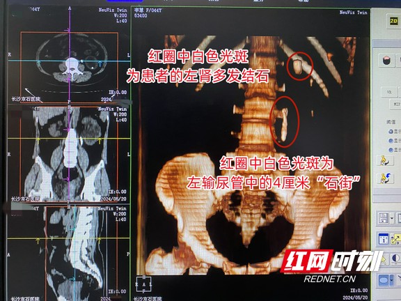 女子腰部频繁胀痛没当回事 岂料结石形成“石街”致肾积水