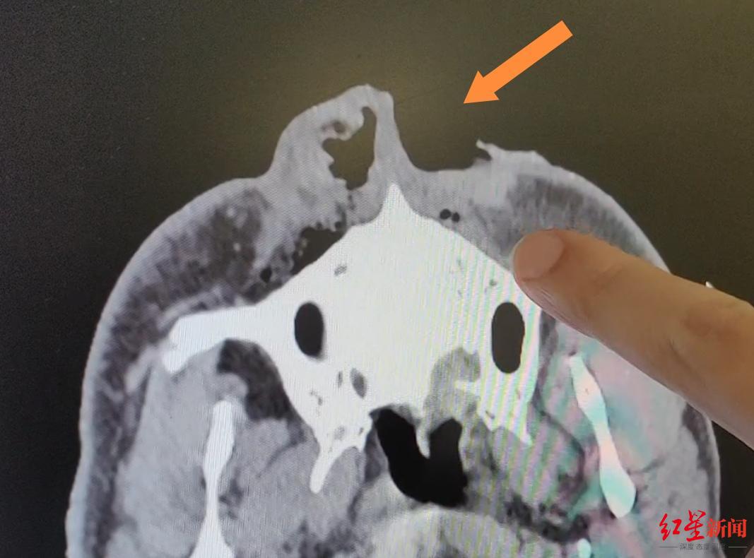 男子上山采菌遭黑熊袭击：被咬掉一半鼻子，狂奔5公里获救