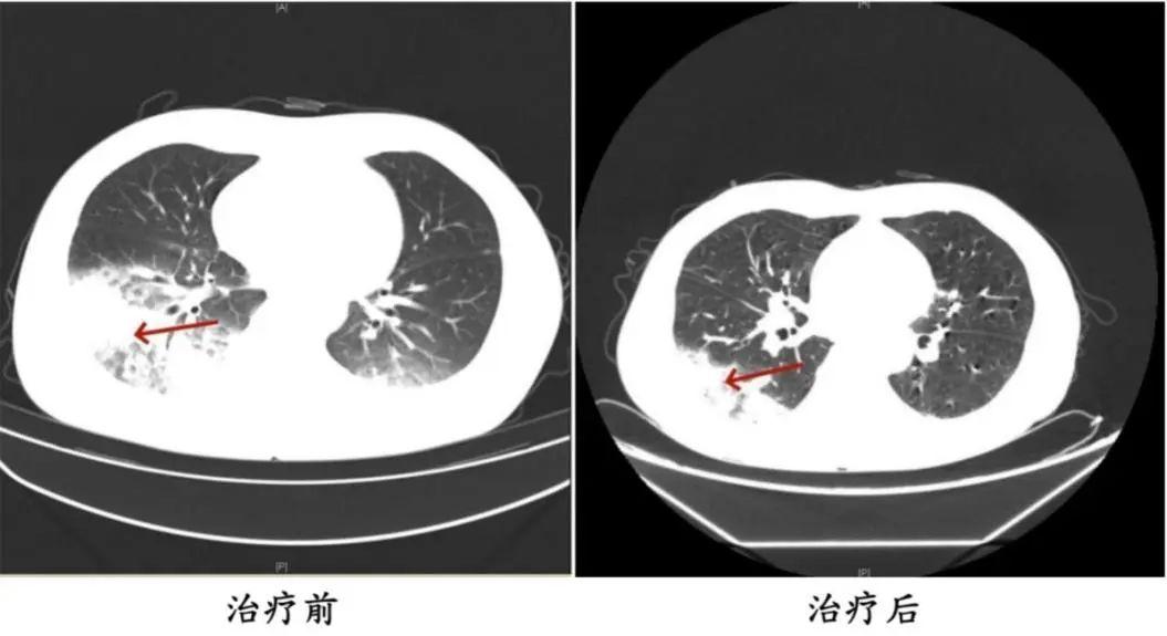 空调长期不洗，男子吹空调后感染“嗜肺军团菌”险丧命