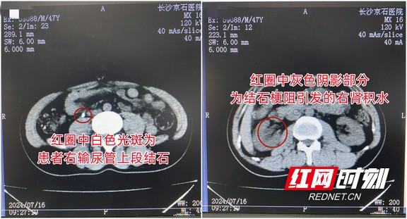 男子高温天干活突发腰痛伴呕吐 以为中暑不料真凶是结石