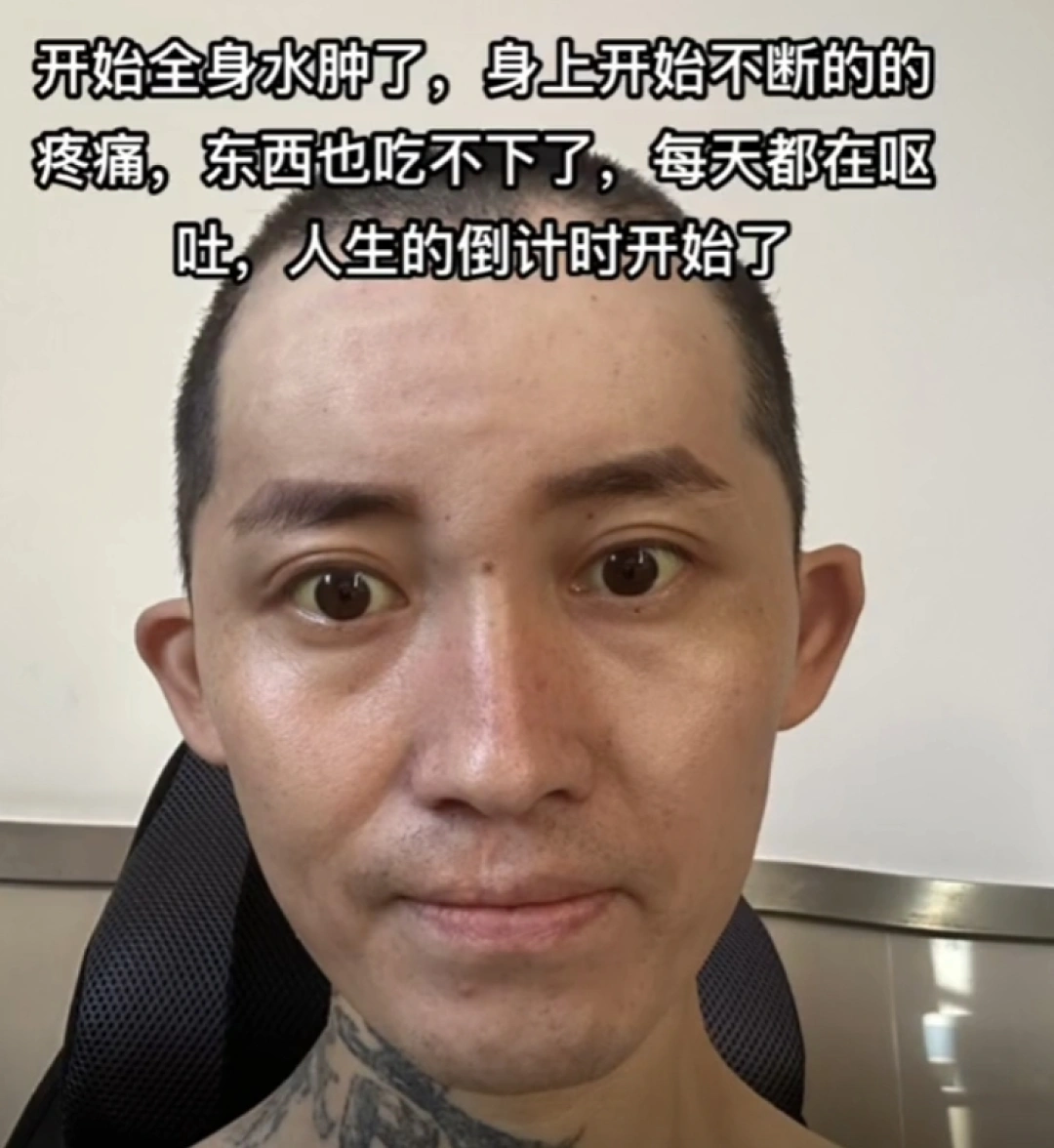 29岁抗癌网红大飞去世，4年前罹患肝癌晚期，村民证实：去世当天被运回家乡