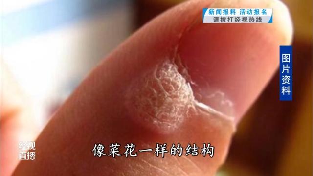 武汉一女子频繁美甲感染HPV，医生：尽量避免做这种美容操作
