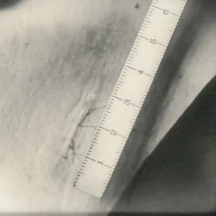 一到夏天就有尴尬体味怎么办?市五院皮肤科帮您告别腋臭