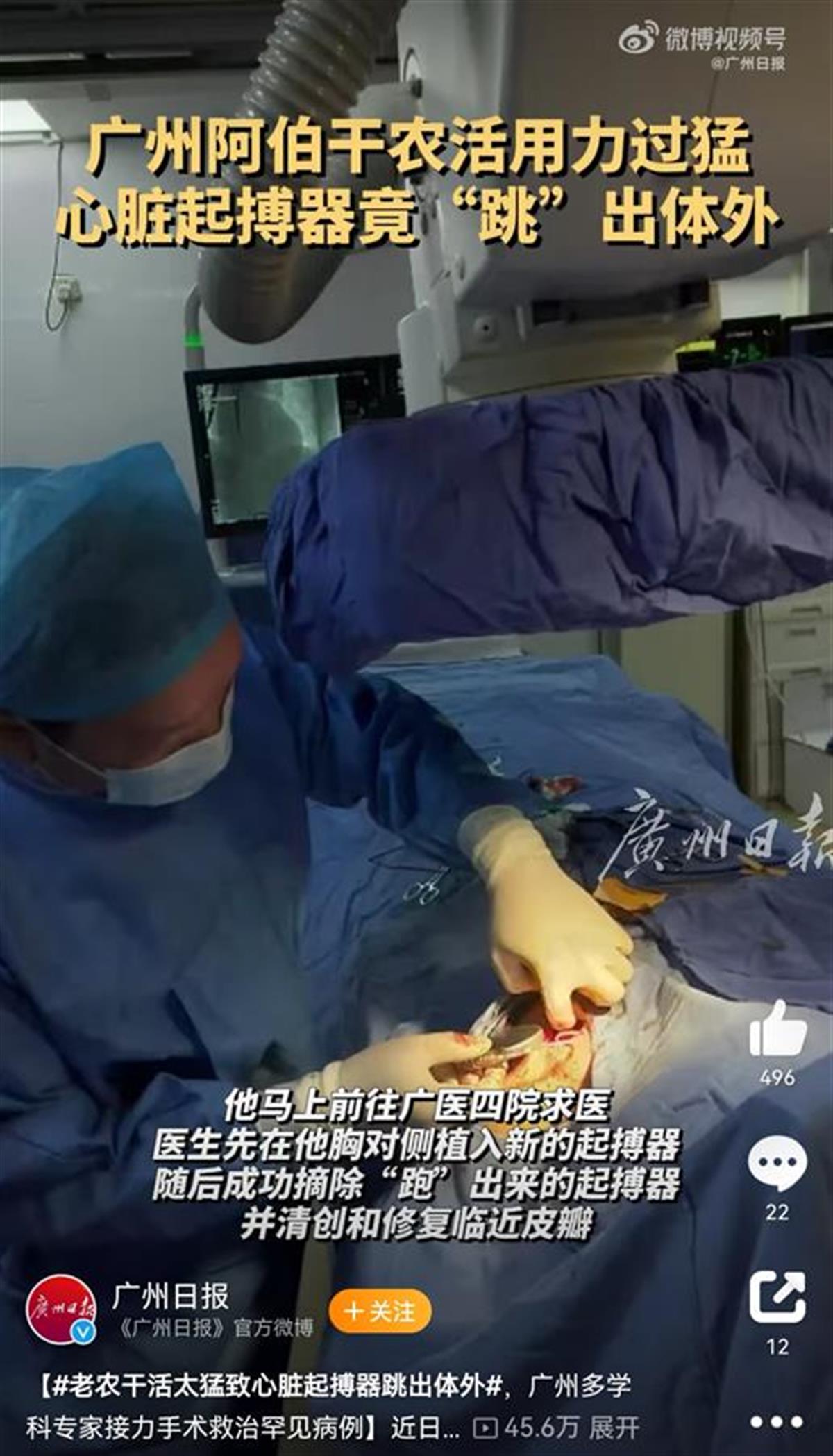 老农干活太猛致心脏起搏器跳出体外，多学科专家接力手术成功救治
