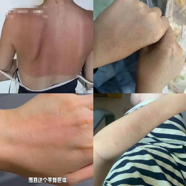 “减肥、除湿、排毒”,号称“免费天灸”的晒背真有那么神吗?