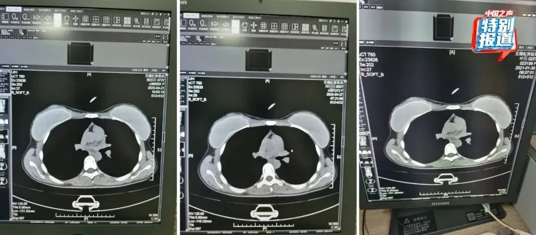 医生实名举报无锡虹桥医院涉嫌骗保，不同年龄三人CT片几乎一样，国家医保局出手了