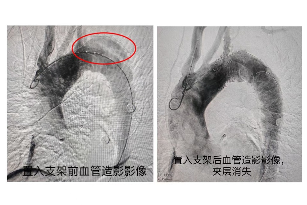 血管置入支架前后對比圖