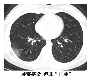 新冠患者出現白肺白肺究竟是咋回事一文講明白