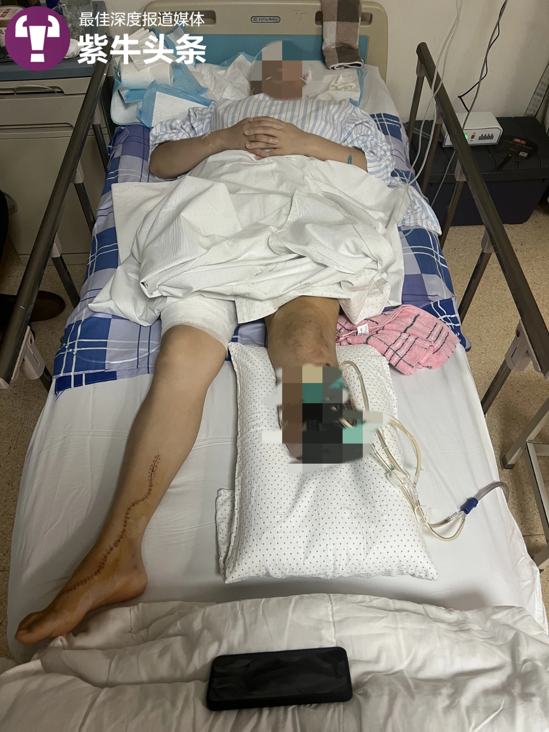 女大学生实习期间救人后被砸断腿截肢，合同没签，保险尚未生效2