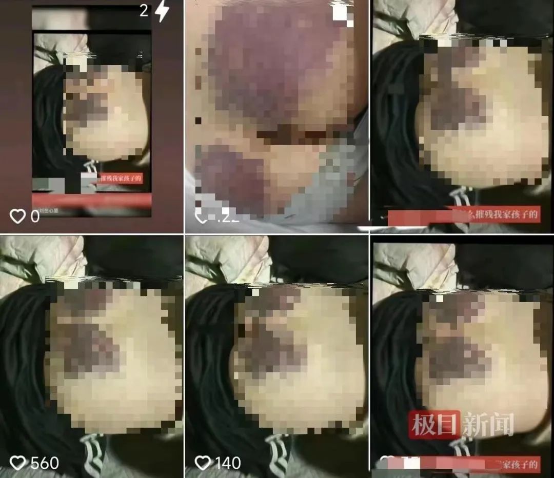 河北保定一学生屁股被老师打成黑紫色？涉事老师停课！1