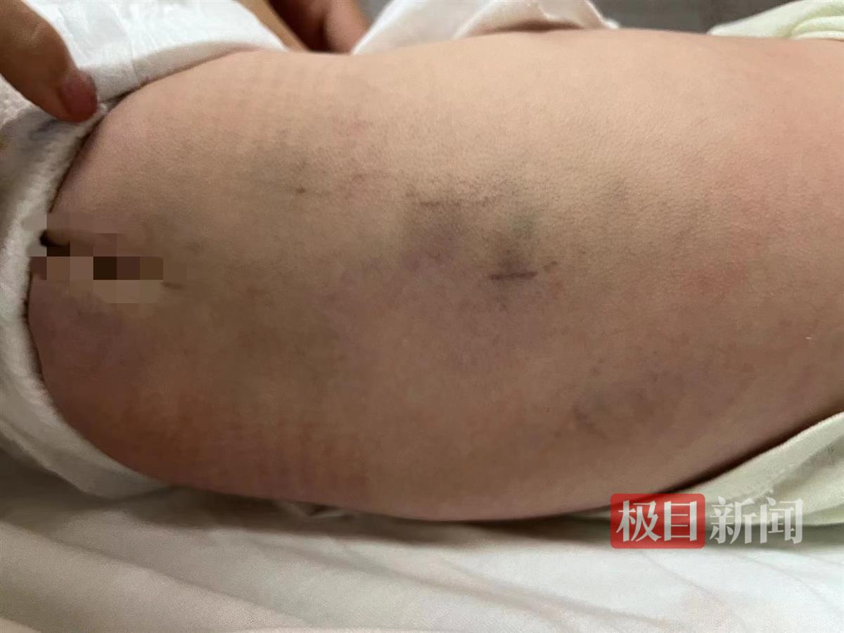 满月男婴被护工拍打后医院诊断脑损伤，月子会所：护工被警方行政处罚并已停职3