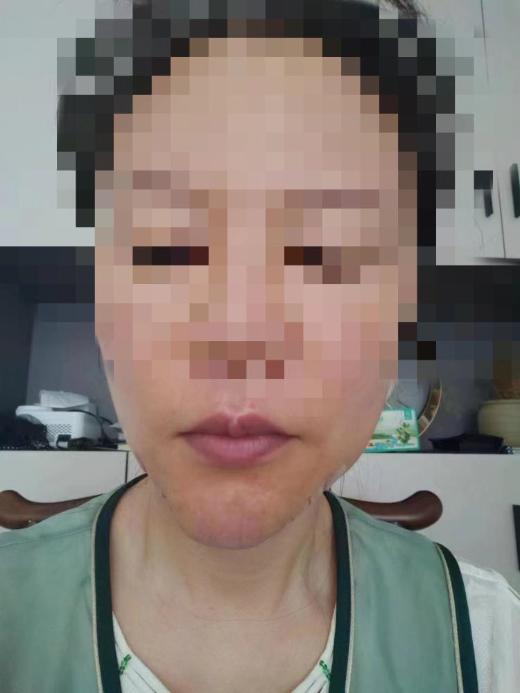 轻医美是风口？三名女子投20多万元，钱没赚到，下巴被“吹”歪了2