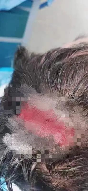 3个月未找到肇事者！长沙男子被天降老干妈瓶砸破头缝7针：“我该找谁赔？”4