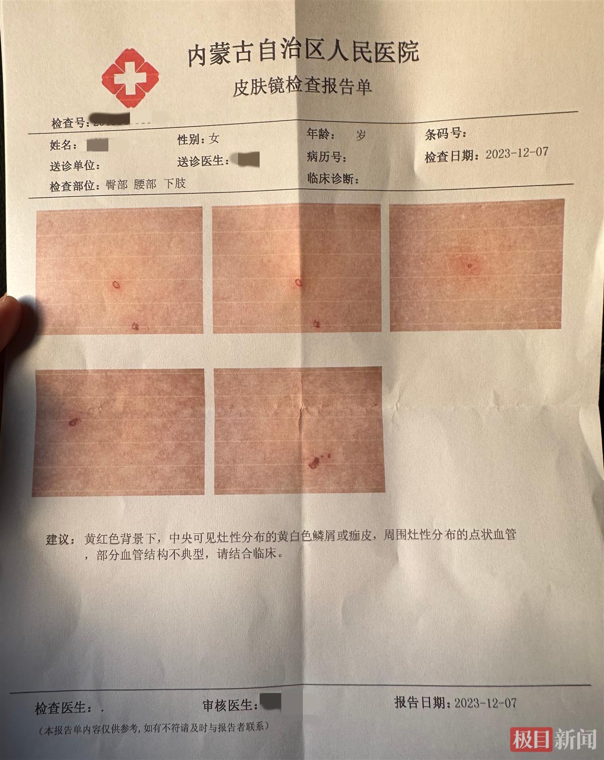 内蒙古一家长怀疑3岁女儿在幼儿园遭针扎，该园两教师曾因针扎幼儿获刑2