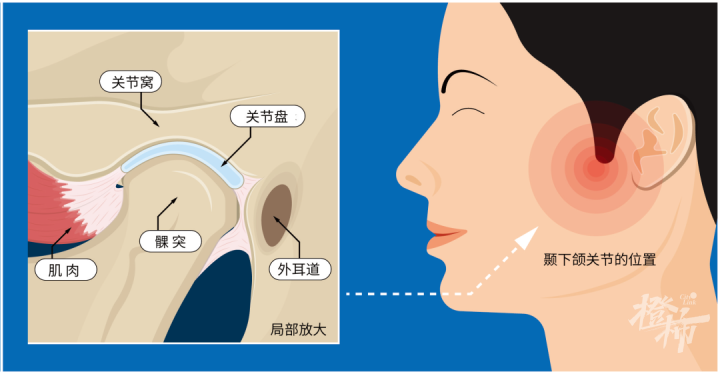 王栎鑫笑到脱臼，“笑掉下巴”原来是得了这种病！20-30岁年轻人高发5
