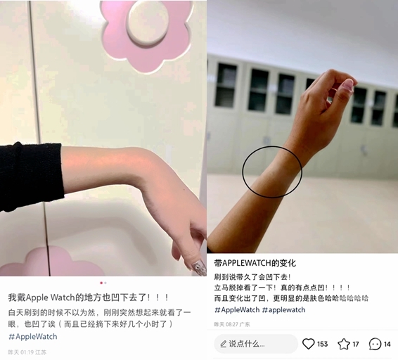 多人网曝戴苹果手表“手凹了” 客服：或与手表背后凸起有关，无影响1