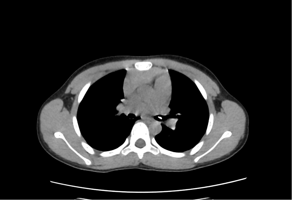 胸部CT提示左主支气管开口处异物