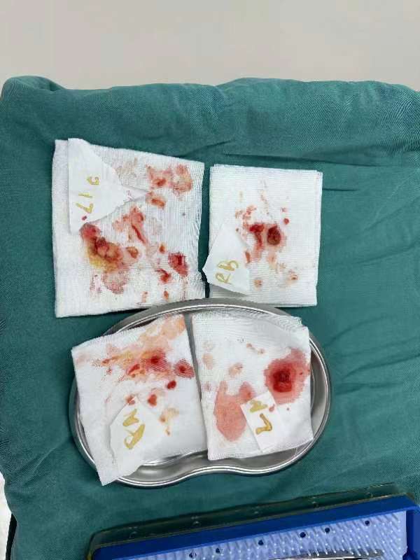 可怕！女子十年前注射“奥美定”填充 如今取出一堆“玉米粒”