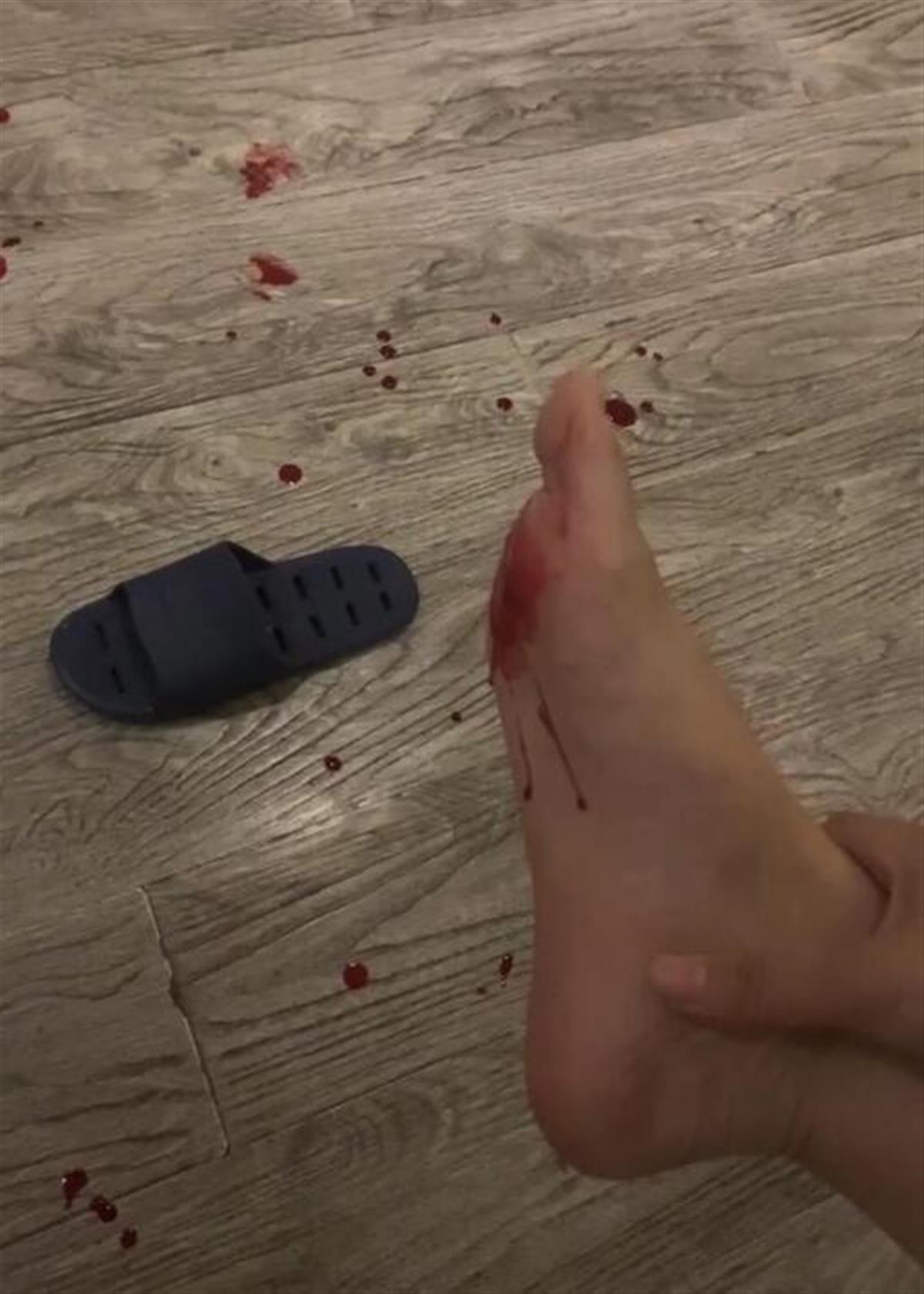女子被酒店拖鞋内藏刀片划伤脚底，担心感染病毒，店方：愿赔3000元2