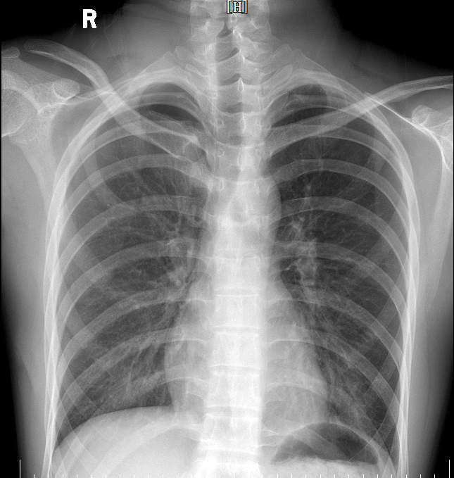 患者术后第一天复查胸片，肺复张可，无胸腔积液表现。