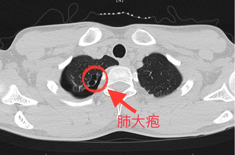患者入院前完善胸部CT提示：右侧气胸，右上肺大疱。