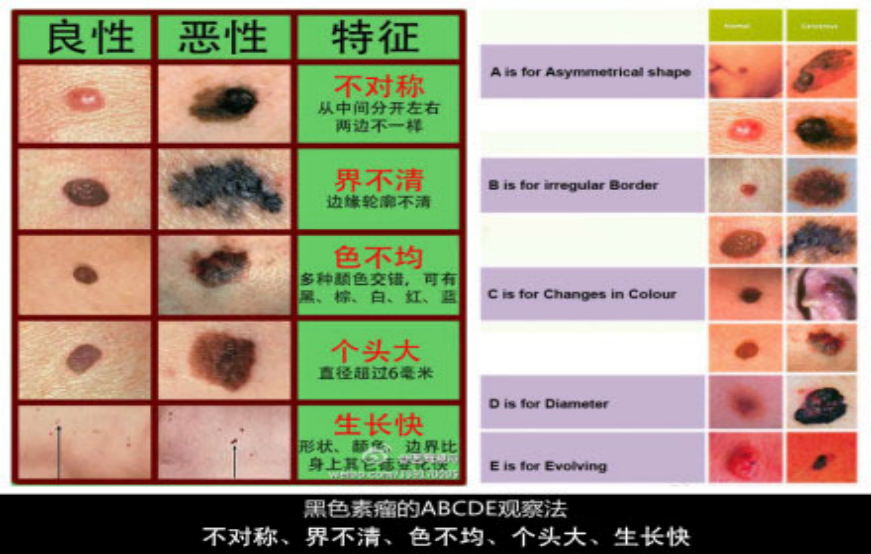 黑色素瘤与普通痣的差别重庆大学附属肿瘤医院供图
