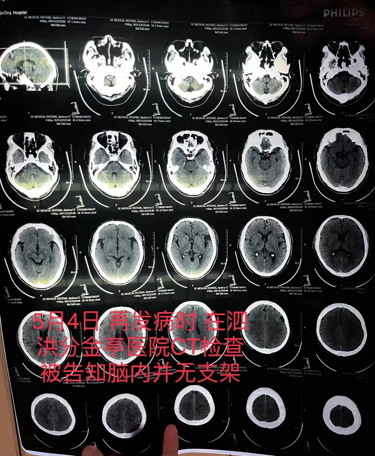 “消失的脑血管支架”追踪:家属称已妥处,卫健部门未回应
