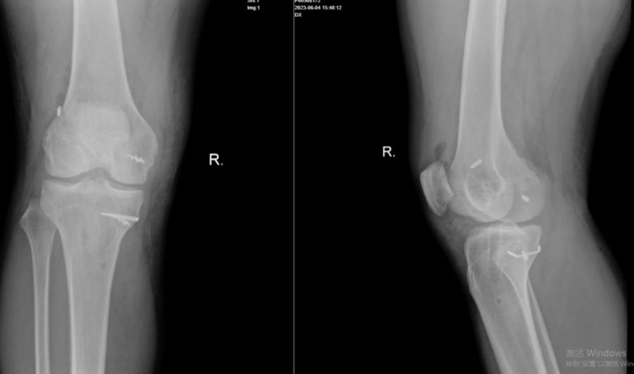 男子膝关节韧带损伤，手术6年后再次疼痛难行3