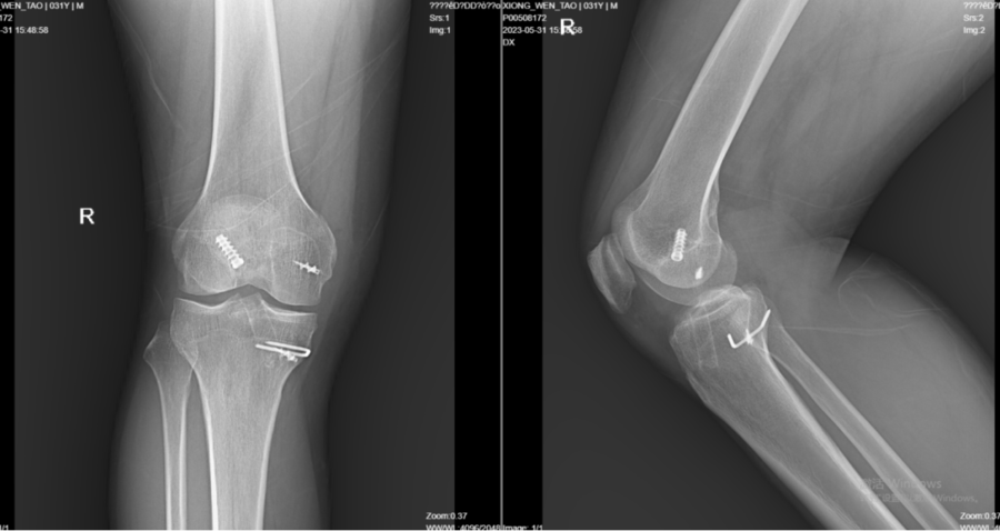 男子膝关节韧带损伤，手术6年后再次疼痛难行1