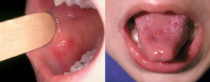 已有多名儿童确诊！高烧可达40℃……近期这病来势汹汹5