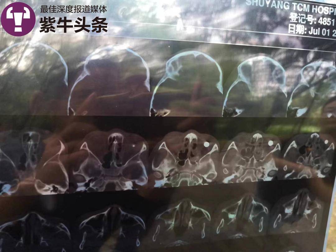 8岁女童左眼被两男孩用钢珠射伤失明：妈妈，我的眼睛什么时候能好啊3