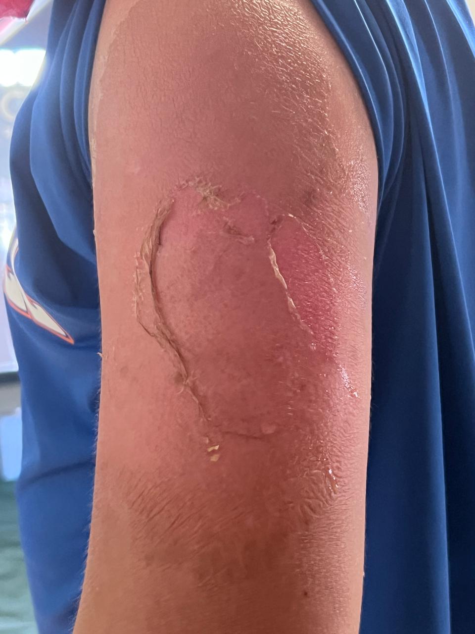 海边游泳2小时，长沙11岁男童被晒伤！医生提醒