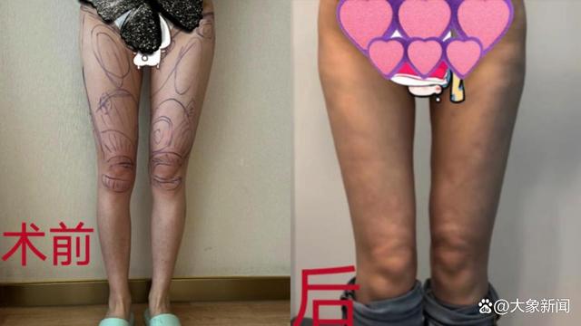 女子吸脂后致腹部凹陷双腿畸形，律师建议：可申请法院进行鉴定4