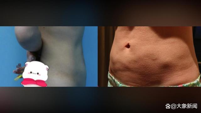 女子吸脂后致腹部凹陷双腿畸形，律师建议：可申请法院进行鉴定3